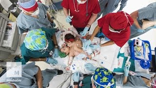 Conjoined Twins Medical Challenges and Surgeries [upl. by Airal]