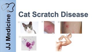 Cat Scratch Disease  Causes Symptoms and Treatment [upl. by Gabriele885]