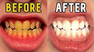 How I Whitened My Teeth in 14 Days [upl. by Assirrem]