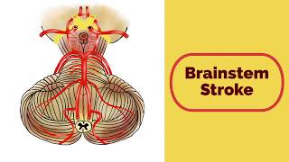 Brainstem Stroke Syndromes [upl. by Enyal846]