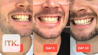 Colgate’s Teeth Whitening Kit Brightens your chops in just 10 days [upl. by Eelram]