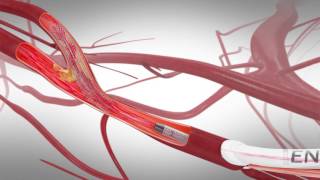 TCAR Transcarotid Arterial Revascularization [upl. by Lefton]