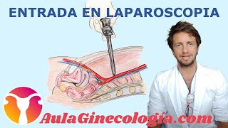 ENTRADA en LAPAROSCOPIA VERESS HASSON DIRECTA TRÓCARES SECUNDARIOS  Ginecología y Obstetricia [upl. by Ydnab]