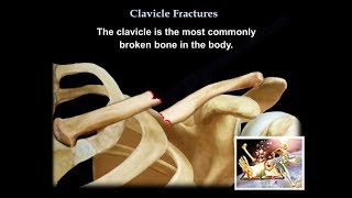 Clavicle Fractures  Everything You Need To Know  Dr Nabil Ebraheim [upl. by Nolahc65]