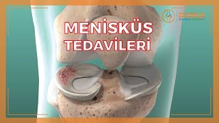 MENİSKÜS SORUNLARI VE MENİSKÜS TEDAVİLERİ [upl. by Lucey]