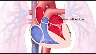 Mitral Valve Regurgitation [upl. by Airyt706]