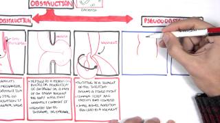 Bowel Obstruction  Causes and Pathophysiology [upl. by Marissa739]