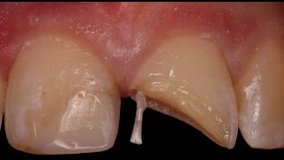 Rebuilding a Fractured Tooth with Pins [upl. by Suiramad]