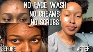 I QUIT USING ACNE PRODUCTS TO CLEAR MY SKIN WPhotos [upl. by Vincents934]