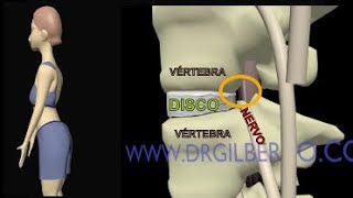 Hernia de Disco  Extrusão Discal  Protusão  Abalamento Dr Gilberto explica [upl. by Ellak602]