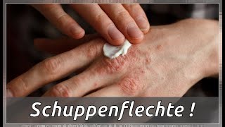 6 natürliche Tipps und Hausmittel gegen Schuppenflechte [upl. by Rett]