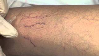 Spider Vein Sclerotherapy [upl. by Firestone]