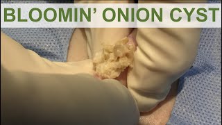 Bloomin Onion Cyst  Dr Derm [upl. by Oek553]