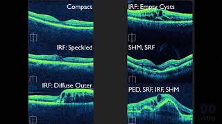 Macular OCT Interpretation A Practical Discussion with Dr David E Lederer [upl. by Ylek]