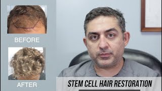 Stem Cell Hair Restoration Success Story [upl. by Nohtan212]