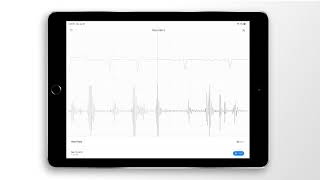 Atrial Fibrillation Combined Heart Sound PCG amp ECG Example  EkoCLINIC App [upl. by Jemie]