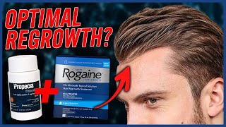 Combining Finasteride amp Minoxidil [upl. by Keeryt]