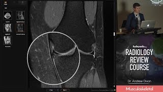 Horizontal Meniscal Tears MRI  Radiology Review Course [upl. by Edmanda744]