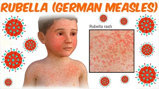 Rubella German Measles [upl. by Koorb]