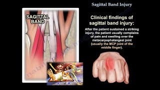 Sagittal Band Injury  Everything You Need To Know  Dr Nabil Ebraheim [upl. by Rothenberg183]