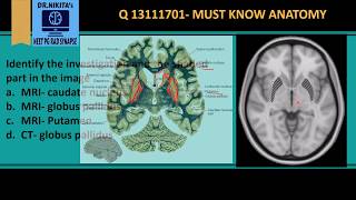 MRI Brain anatomy  Basal ganglia [upl. by Yrbua191]