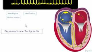 ECG Rhythm Review SVT Atrial Fibrillation Atrial Flutter [upl. by Aridan474]