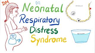 Neonatal Respiratory Distress Syndrome NRDS  Pediatrics  Pulmonology [upl. by Pimbley]