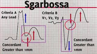 Current ECG Ep 4 Sgarbossa Criteria STEMI LBBB [upl. by Tehr103]