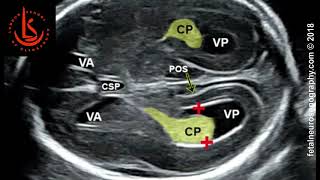 New UOG video abstract on placenta previa and low‐lying placenta second trimester ultrasound [upl. by Siramaj]