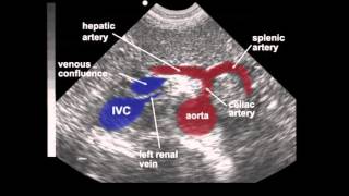 Abdominal Aortic Aneurysm AAA Ultrasound [upl. by Enilegnave877]