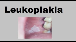 Leukoplakia [upl. by Tterrab]