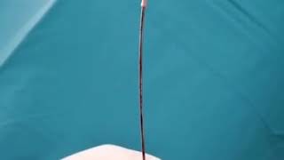 Fogarty arterial embolectomy catheter [upl. by Ninahs]